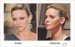 aumento de labios