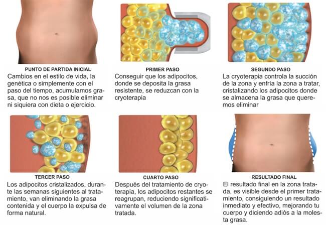 Criolipólisis, la nueva técnica para eliminar grasa sin cirugía