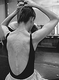 anorexia1