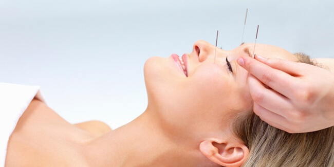 Acupuntura estética, el último tratamiento de moda entre las famosas