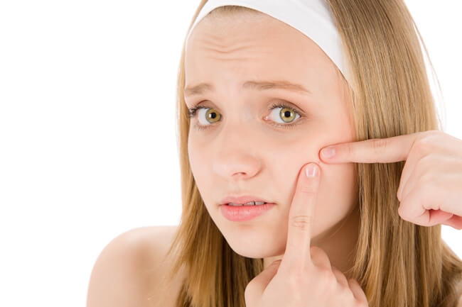 Trucos para eliminar el acné
